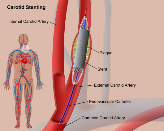 Carotid Angioplasty