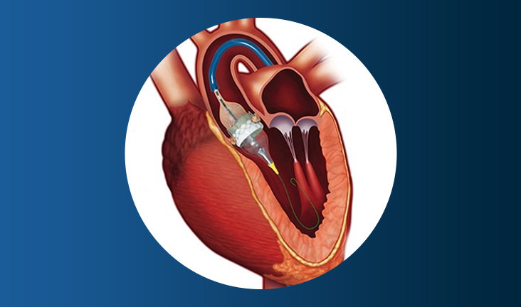 TAVI Surgery in Navi Mumbai by Dr. Mahesh Ghogare