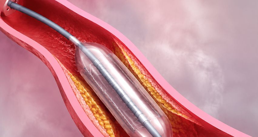 Coronary angioplasty by Dr. Mahesh Ghogare in Navi Mumbai