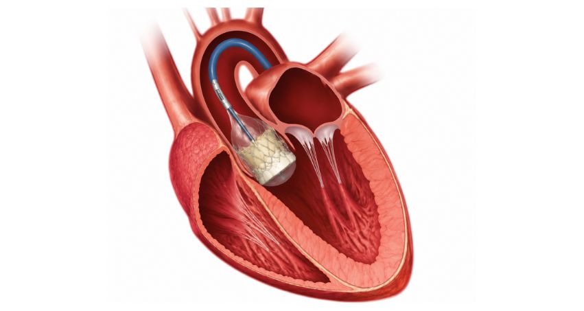 TAVI surgery for aortic stenosis by Dr. Mahesh Ghogare in Navi Mumbai