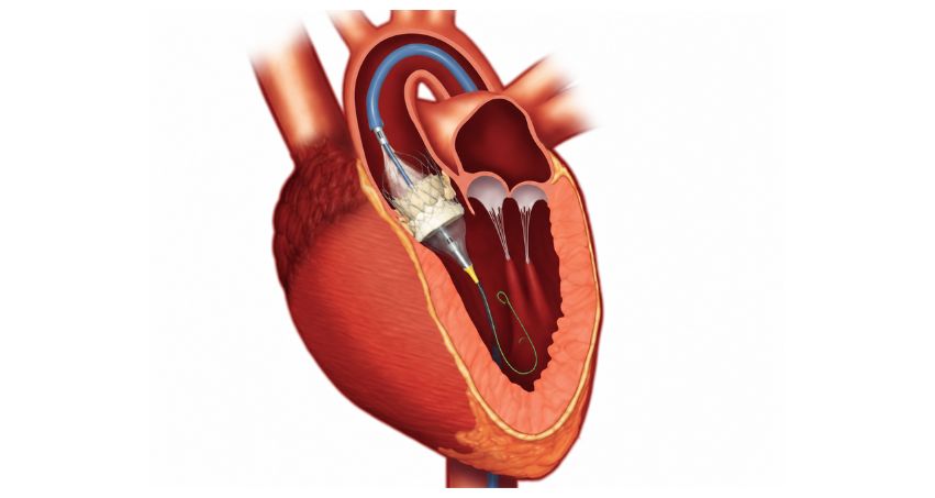 TAVR surgery for aortic stenosis by Dr. Mahesh Ghogare in Navi Mumbai
