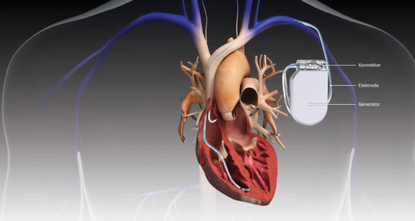 pacemaker-implantation